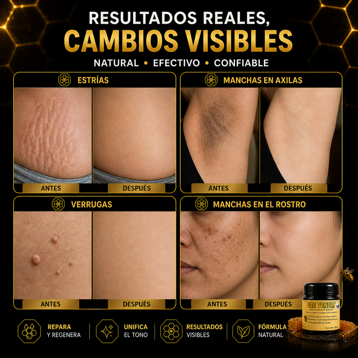 🐝 Been Venom® - Formula Americana para Estrías, Manchas, Verrugas y Marcas Difíciles